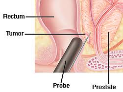 prostat biyopsisi