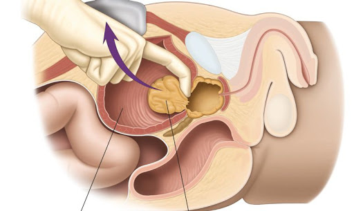 Prostat ameliyatında prostatın içi alınır, kabuğu bırakılır.
